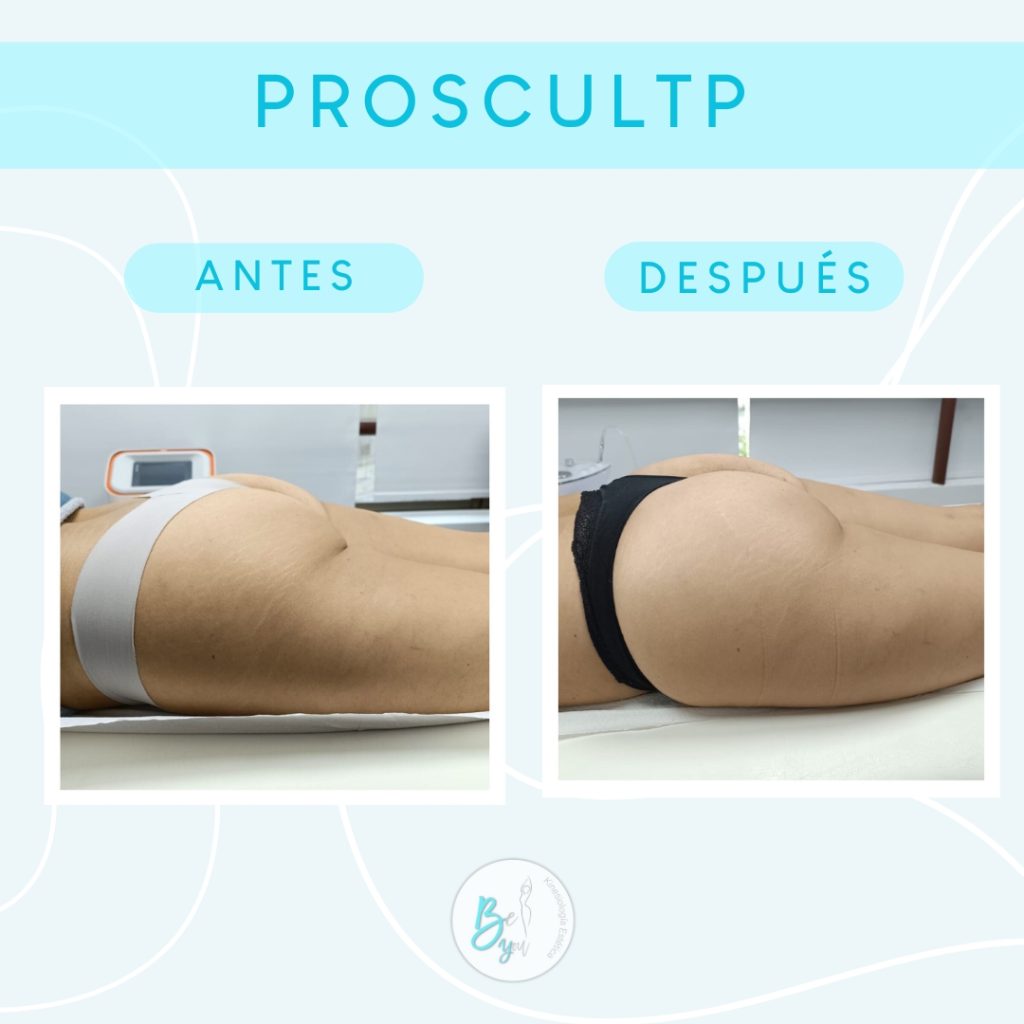 Prosculpt 5