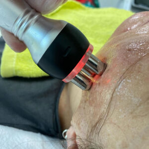 Limpieza con Radiofrecuencia