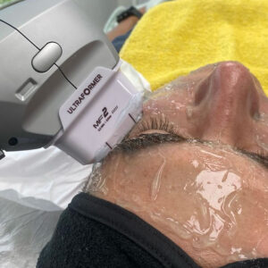HIFU Facial