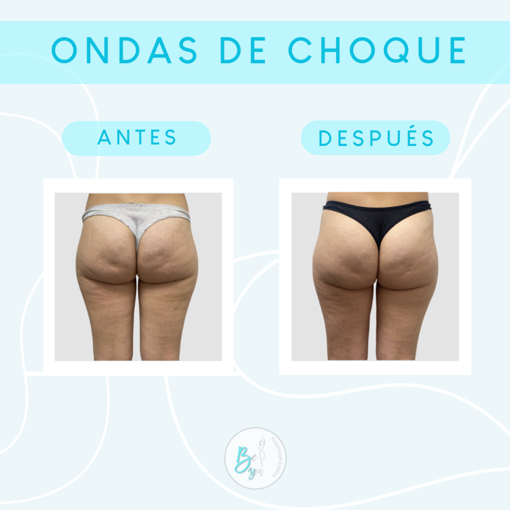 ondas de choque