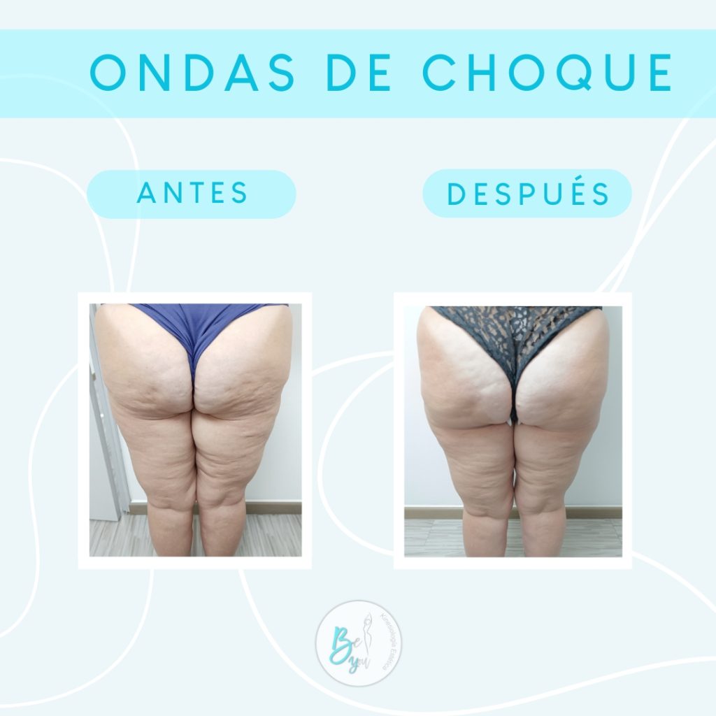 ondas de choque 3