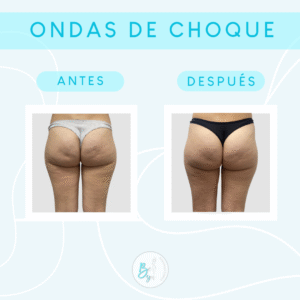 Onda de choque