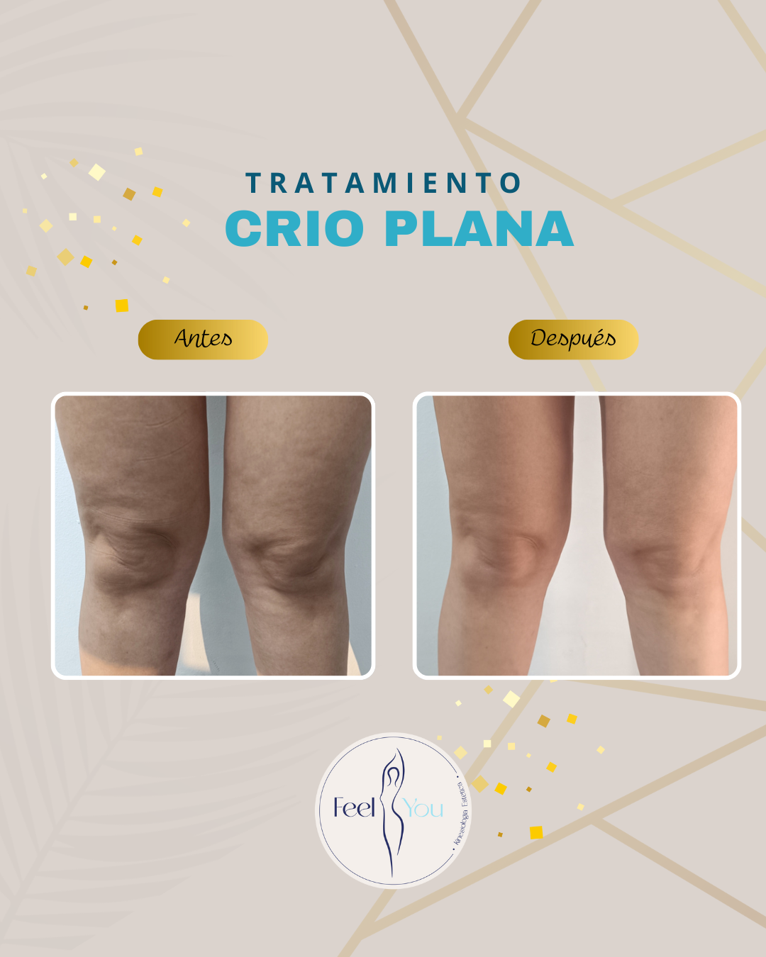 Criolipólisis Plana - Imagen 5