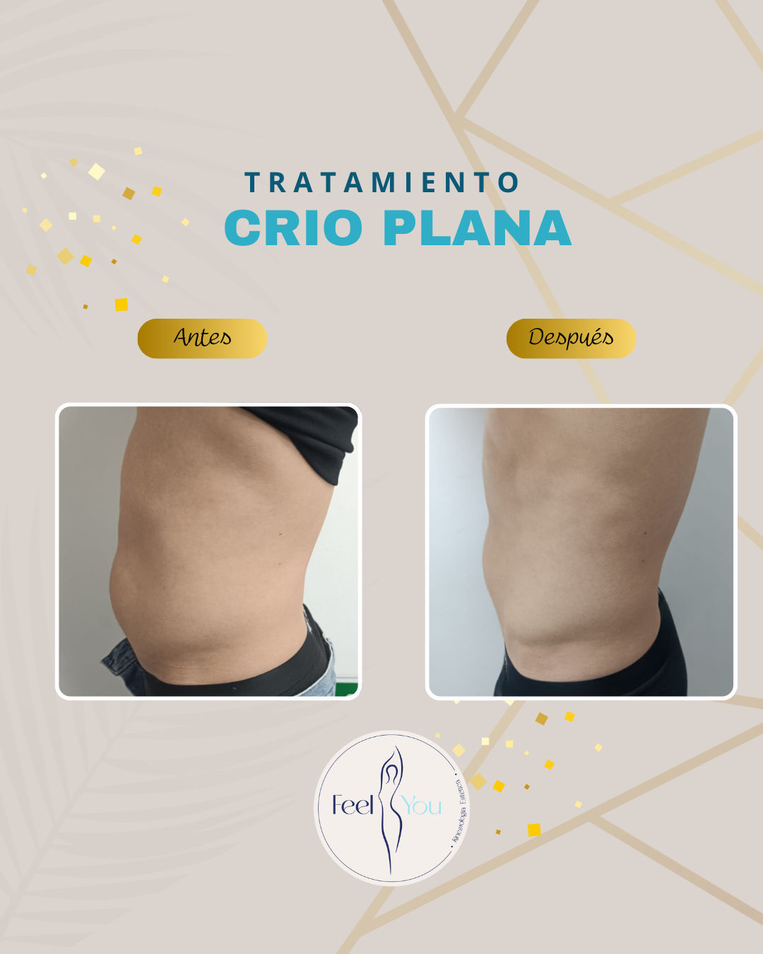 Criolipólisis Plana - Imagen 3