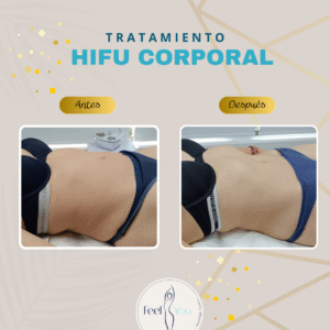 HIFU Corporal