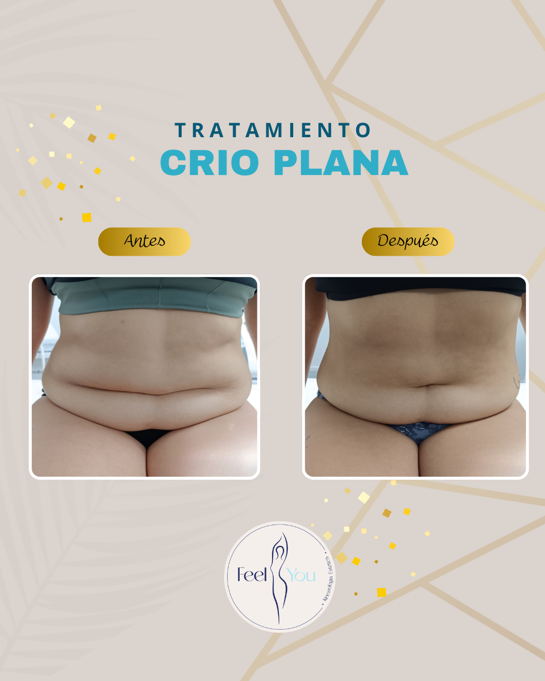 Criolipólisis Plana - Imagen 2