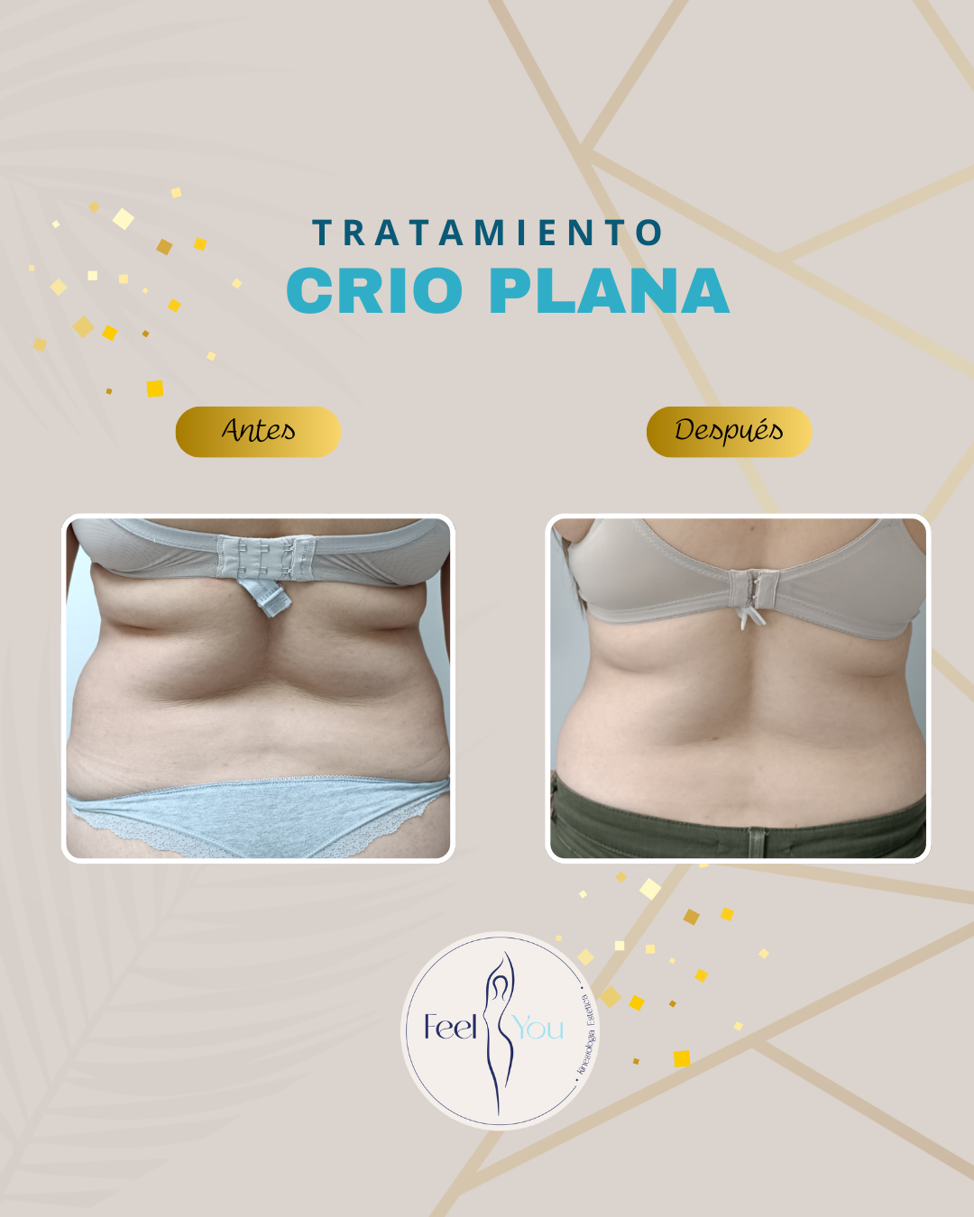 Criolipólisis Plana - Imagen 4